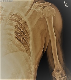 x-ray_of_upper_left_arm_2017-Mar-06.jpg